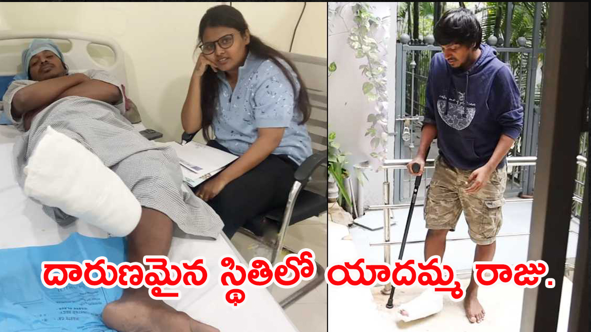 యాక్సిడెంట్ తర్వాత దారుణమైన స్థితిలో కమెడియన్ యాదమ్మ రాజు.